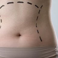 Liposuctioninislamab