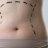Liposuctioninislamab